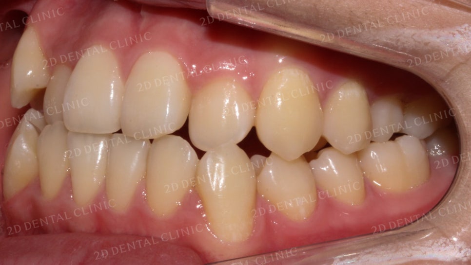 덧니치아교정, 클리피씨 전체교정으로 완벽하게! by.투디치과(2D치과) 관련 이미지 5