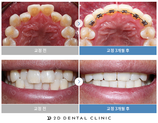 2D Plus+(플러스) 교정, 심한 케이스도 티 나지 않게! 관련 이미지 8