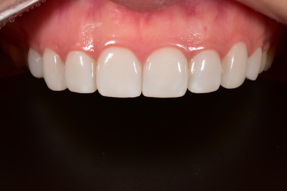 [투디치과] 블랙필름(비스포크) 치료의 다양한 사례 관련 이미지 7