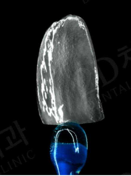 무삭제 라미네이트 부작용 없는 치아성형시술 블랙필름 관련 이미지 2