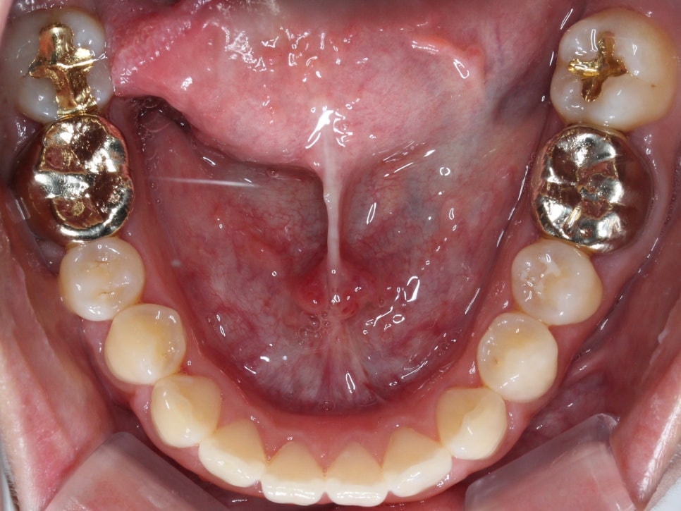 덧니 투명교정 8개월 치료 사례 관련 이미지 11