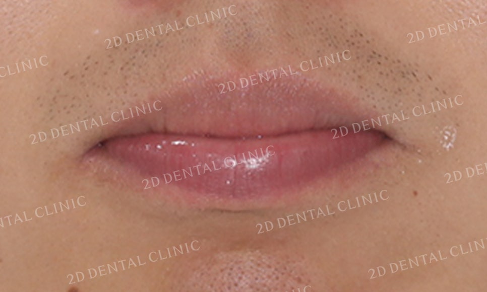 돌출앞니 교정, 튀어나온 입을 넣어보자! by.투디치과(2D치과) 관련 이미지 2