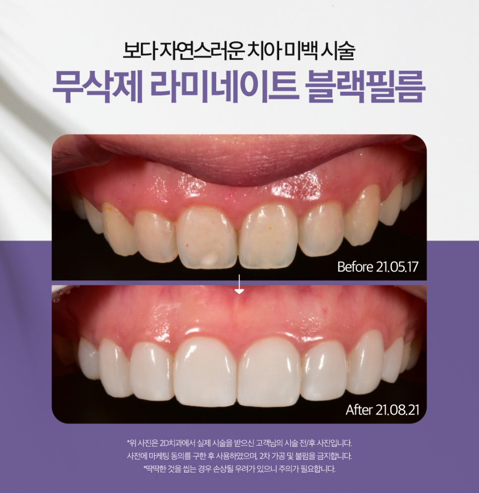 블랙필름무삭제라미네이트 치아미백후 착색되지는 않을까? 관련 이미지 5