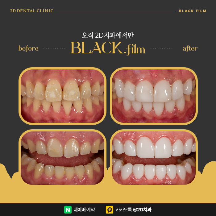 라미네이트 단점은 치아삭제? 강남 라미네이트전문 2D치과 블랙필름 관련 이미지 7