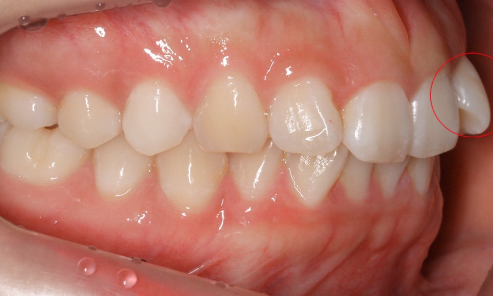 세라믹교정 앞니틀어짐 교정 사례 관련 이미지 5