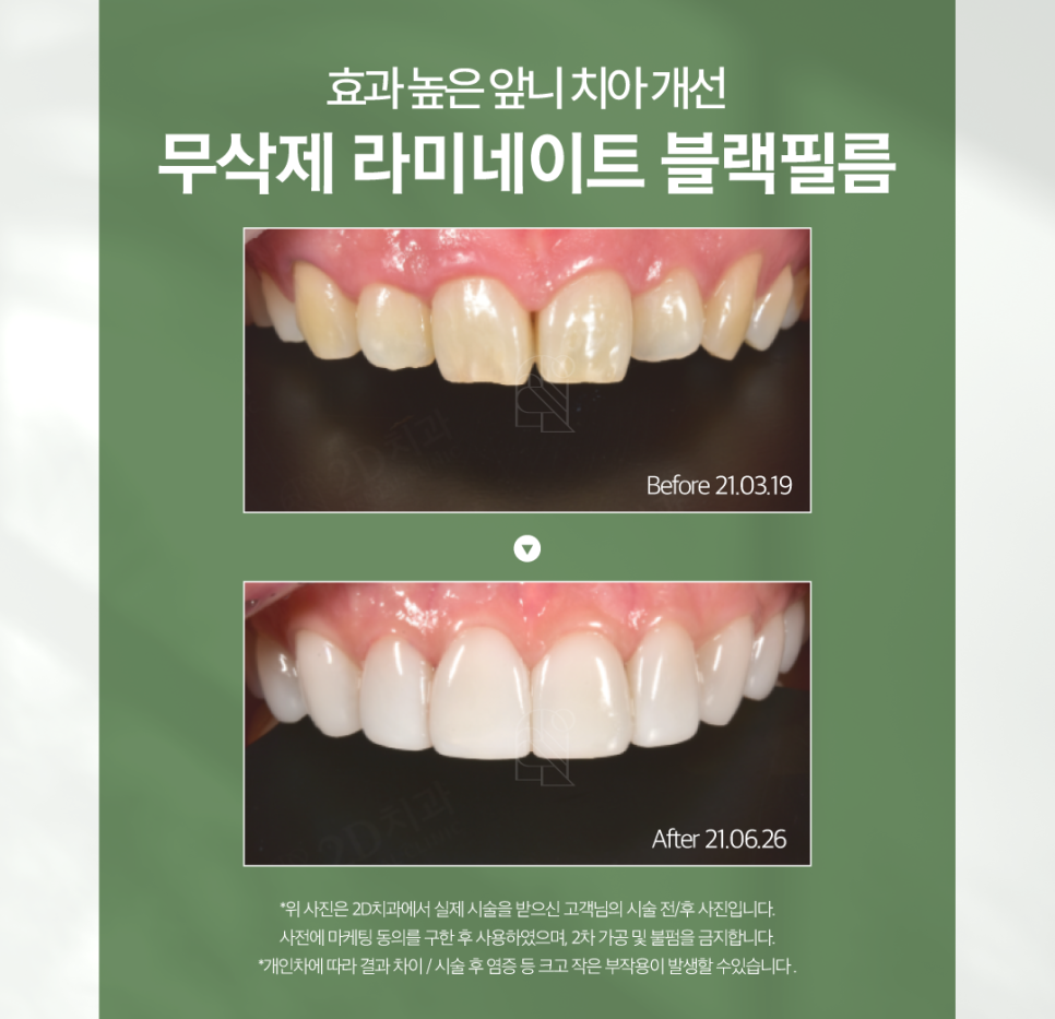 전주무삭제라미네이트 나비치아 안으로 쏠린 앞니도 반듯하게 관련 이미지 7