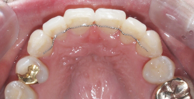 결혼식 6개월 남기고 급속교정으로 토끼이빨 탈출! 관련 이미지 5