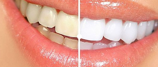 치아변색 고민없는 무삭제라미네이트 블랙필름 관련 이미지 2