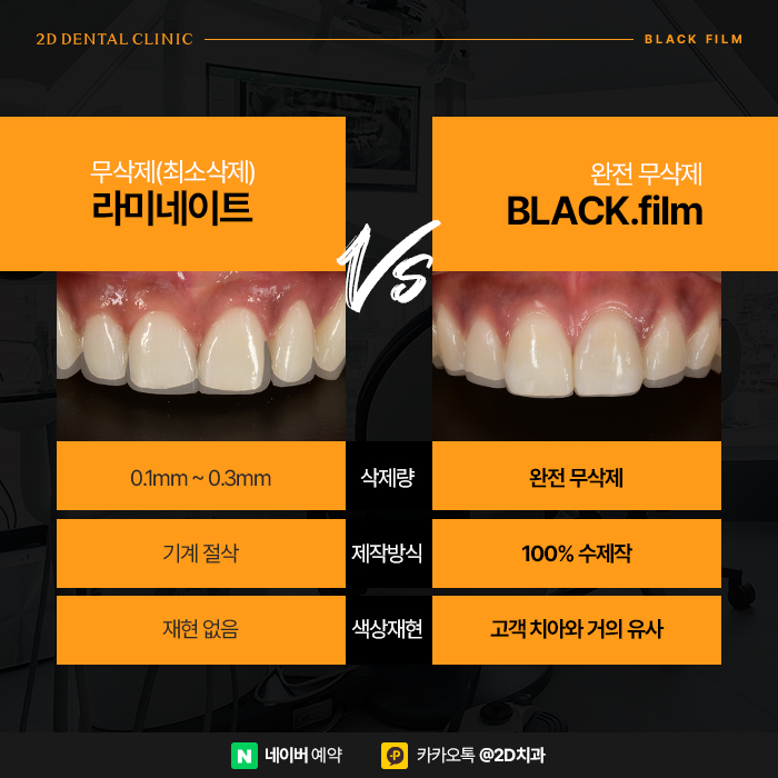 무삭제라미네이트 치아삭제에 대한 부담 없는 후기 관련 이미지 6