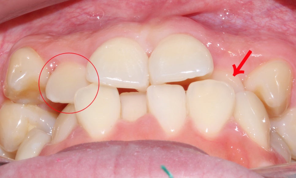 송곳니덧니 교정하는 방법! 관련 이미지 2