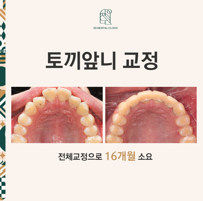 [앞니교정] 토끼앞니교정, 클리피씨 교정으로 완벽하게! by.투디치과(2D치과) 관련 이미지 1
