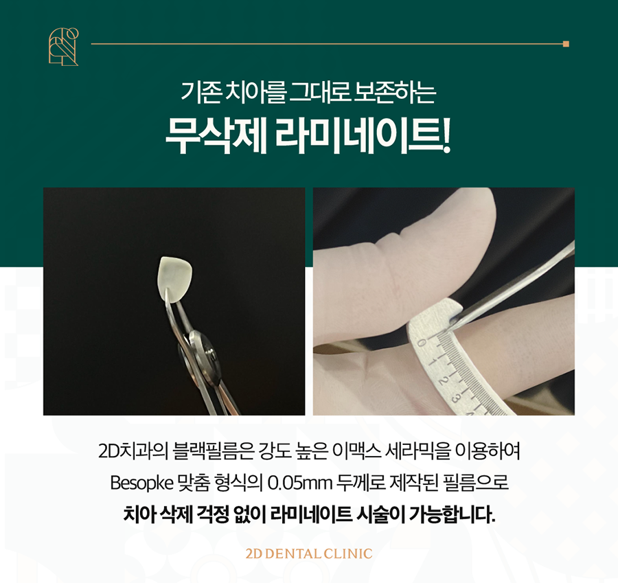 전주무삭제라미네이트 앞니 고민 개선은 블랙필름으로 관련 이미지 4