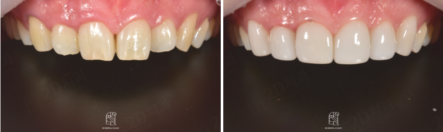 치아라미네이트 잘 하는 투디치과 관련 이미지 17