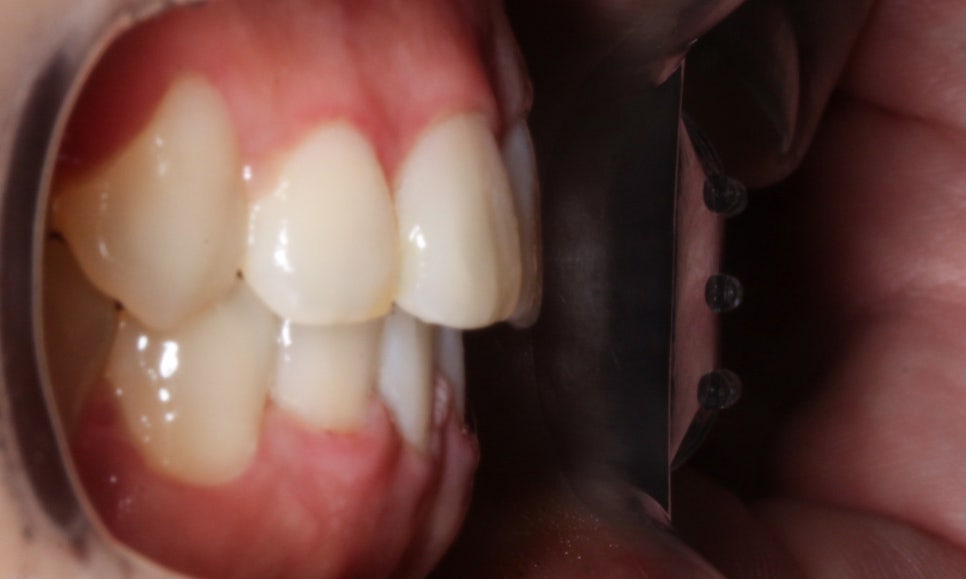 역삼역치과 송곳니덧니 crowding Case 관련 이미지 10