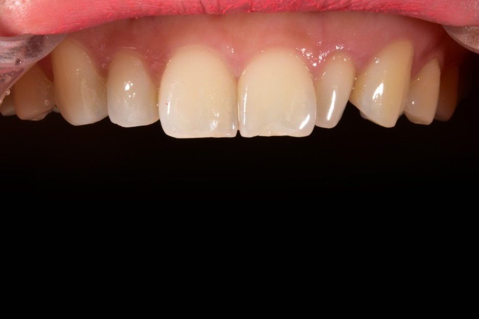 [투디치과] 블랙필름(비스포크) 치료의 다양한 사례 관련 이미지 23