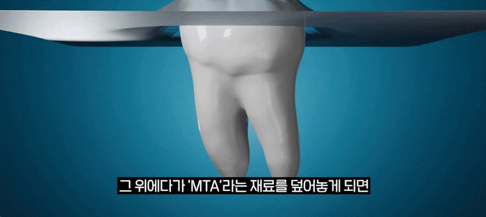 신경치료 없이 크라운 가능 여부와 신경보존술 팩트 체크까지 관련 이미지 13