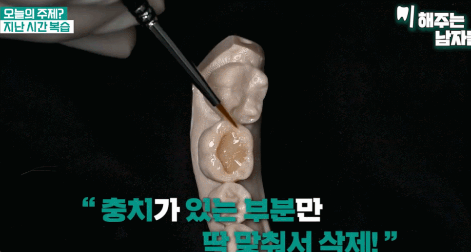 충치레진 vs 인레이&middot;크라운 차이, 언제 결정될까요? 관련 이미지 3