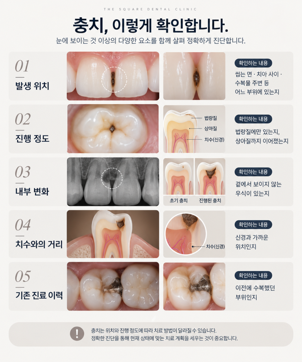 광화문치과, 충치 치료 비용이 달라지는 이유 관련 이미지 5