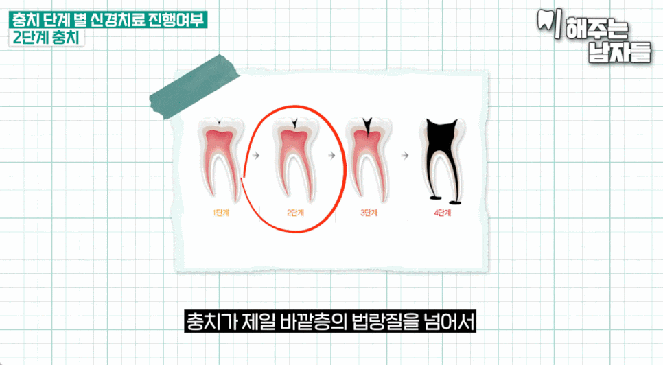 Practical Advice on Root Canal Treatment Duration & Tips for Avoiding Overtreatment image 8