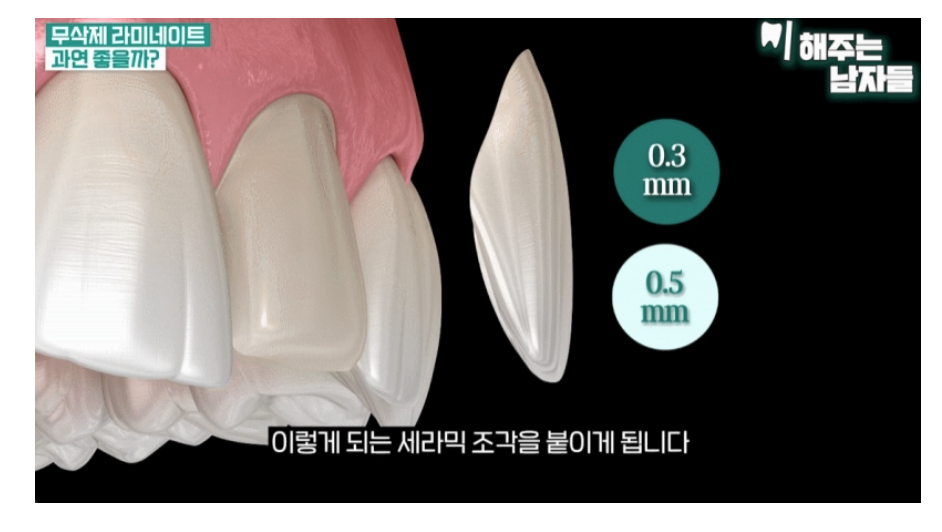 라미네이트치아삭제? 적게 깎는 게 중요한 게 아닙니다. 관련 이미지 2