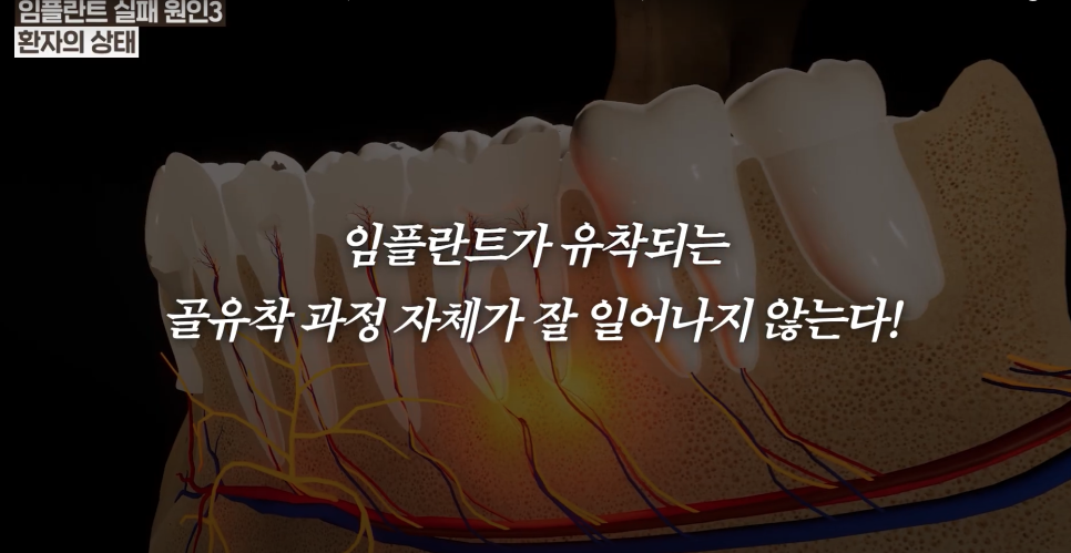 Cheongjin-dong Implants: There Is Clearly a Reason Some People Use Them for Many Years image 5