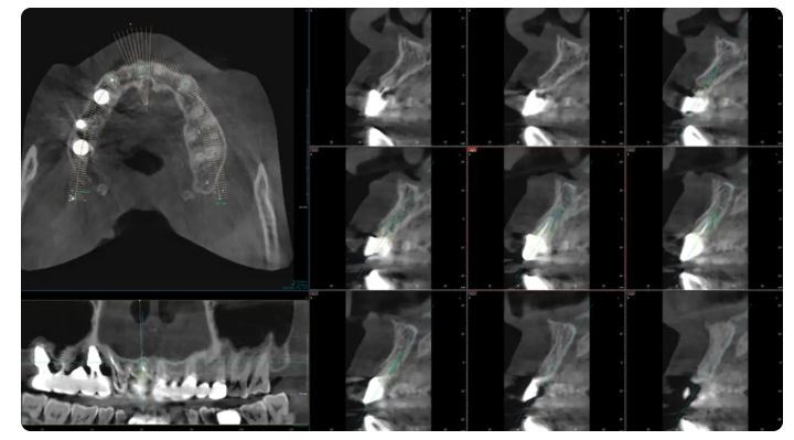 임플란트저렴한곳? 저렴함 뒤에 숨겨진 차이를 보셔야 합니다. 관련 이미지 5