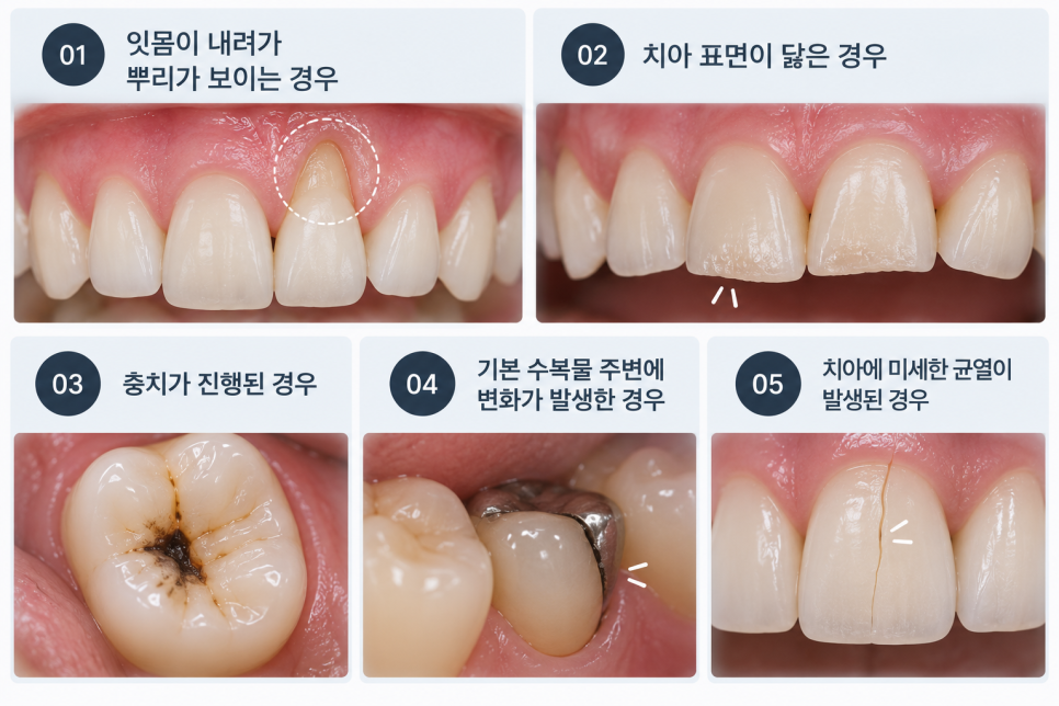 이가시린이유, 어금니 금갔을때 나타날 수 있는 증상은? 관련 이미지 4
