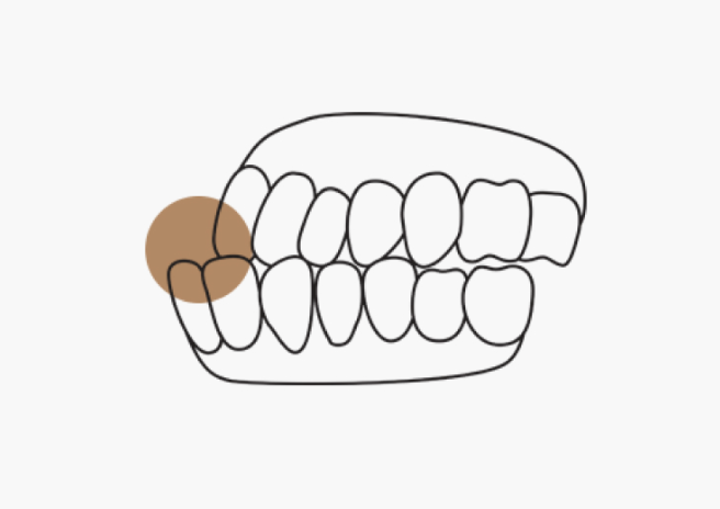 주걱턱교정, 정말 수술만 답일까요? 기준은 따로 있습니다. 관련 이미지 2