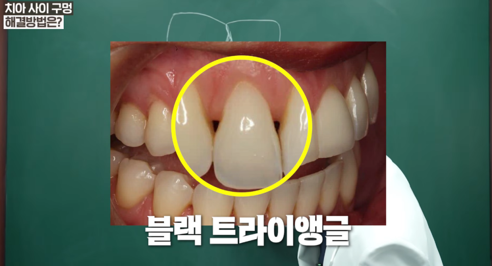 교정후치아벌어짐 원인 및 심미치료로 해결하는 법 A to Z 관련 이미지 5