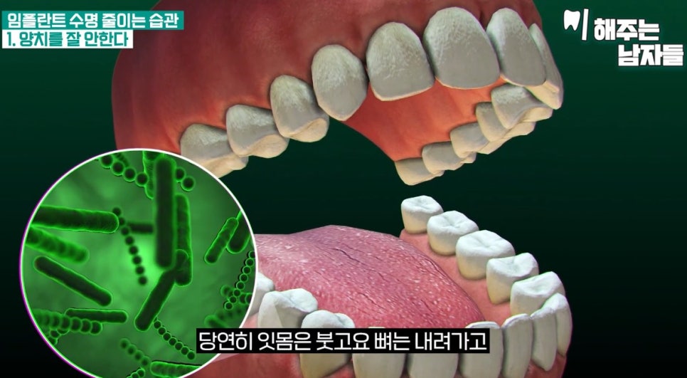안국역치과, 임플란트 수명을 길게 유지하고 싶다면 관련 이미지 2