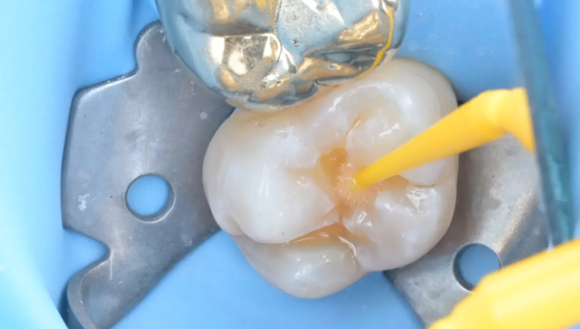 앞니사이벌어짐, 1mm의 선택이 인상을 좌우합니다. [레진빌드업치과] 관련 이미지 5