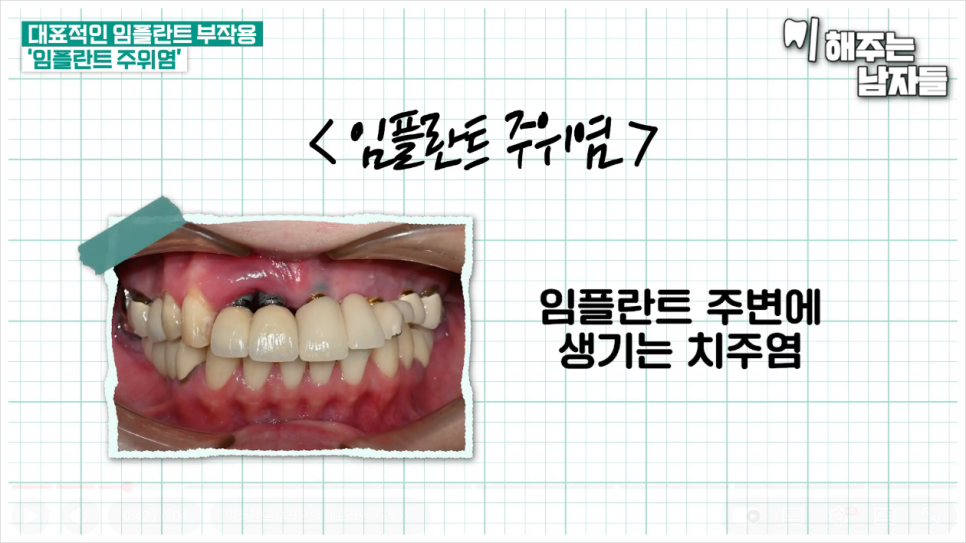 Everything You Need to Know About Peri-Implantitis, from Its Causes to Prevention image 5
