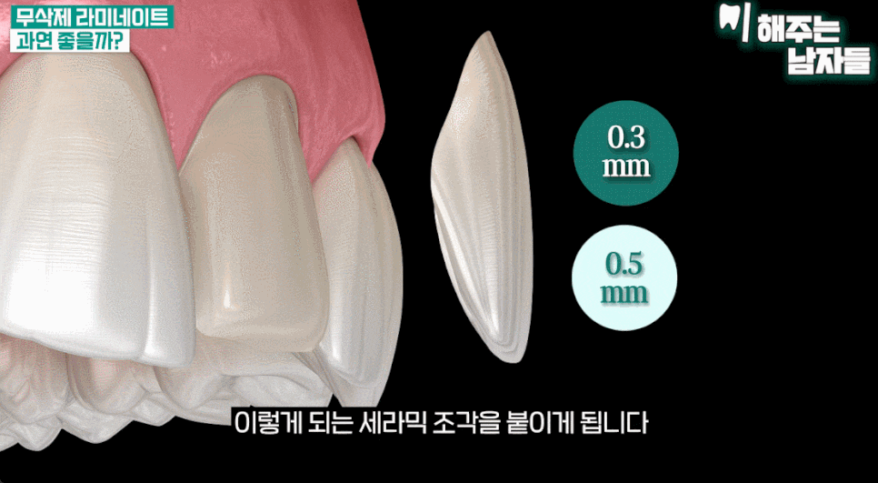 최소삭제라미네이트, 삭제량보다 더 중요한 한 가지 관련 이미지 3