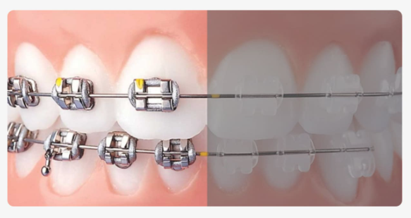 치아교정기종류, 눈에 안 보이는 장치가 더 좋을까요? 관련 이미지 2