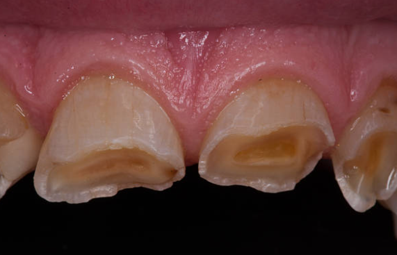 앞니마모, 예전보다 앞니가 짧아 보인다면 확인해 보셔야 합니다. 관련 이미지 3