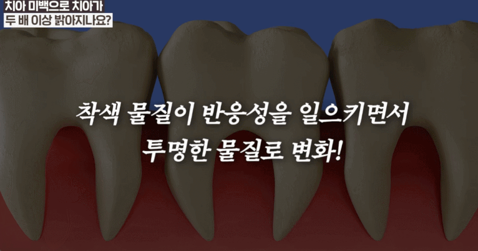 누런치아 하얗게 하고  싶다면? 자가미백 전에 관련 이미지 5