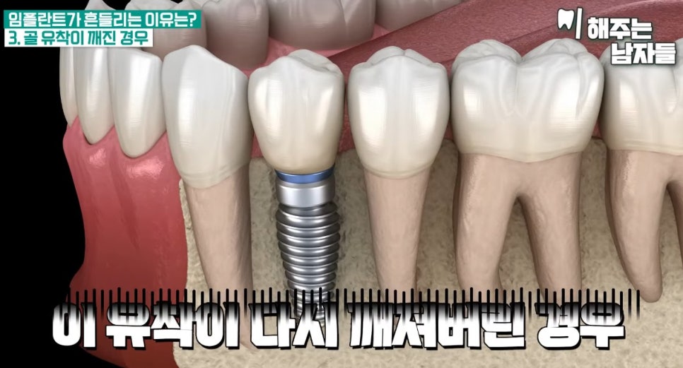 충정로치과, 임플란트가 흔들리는 이유는? 관련 이미지 6