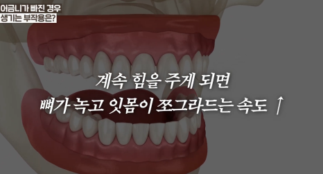 충무로치과 임플란트 어떤 경우에 해야할까? 관련 이미지 6