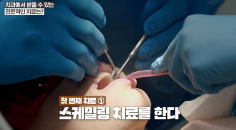 My Gums Hurt: A Complete Guide to Gum Bleeding While Brushing, Home Care, and Dental Gum Treatment image 14