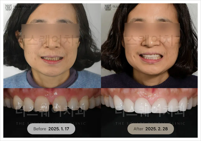 An Article for Anyone Hesitating About Front Tooth Minishe and Laminates image 9