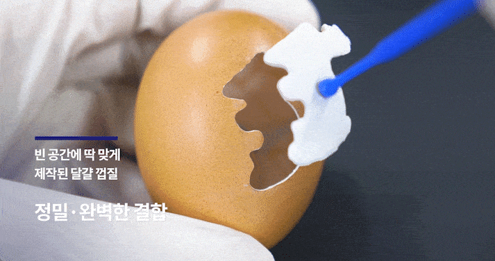왜소치 교정, 작은 치아 무작정 키우기 전 알아야 할 팩트 관련 이미지 11