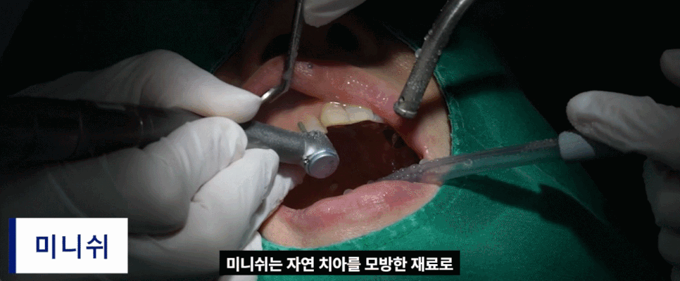 치아 미니쉬 고민 중이라면, 결정 전에 꼭 봐야 할 3가지 기준 관련 이미지 3