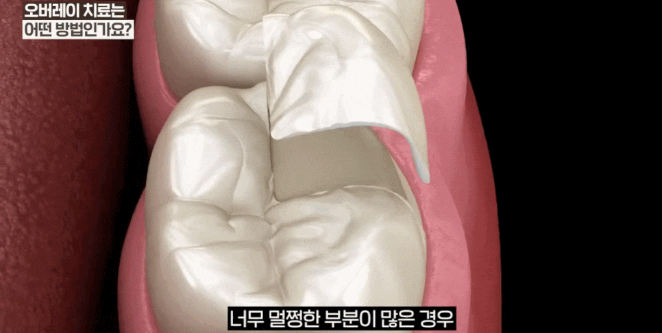 신경치료후크라운안하면 위험할까? 오버레이치료 가능한 기준 관련 이미지 6