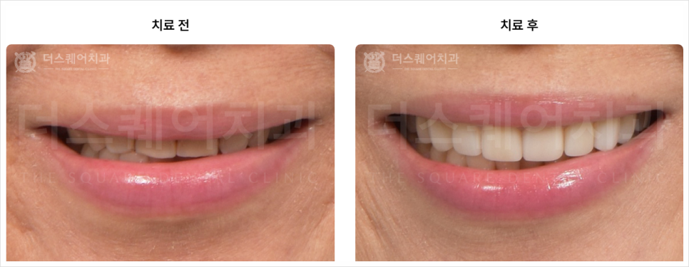 How to Whiten Yellow Teeth with Teeth Minish vs. Teeth Whitening Treatment image 15