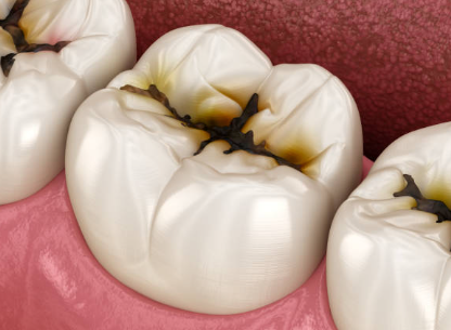 충치레진 vs 인레이&middot;크라운 차이, 언제 결정될까요? 관련 이미지 4