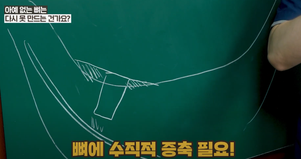 광화문 임플란트 할 때, 뼈이식이 필요한 이유 관련 이미지 7