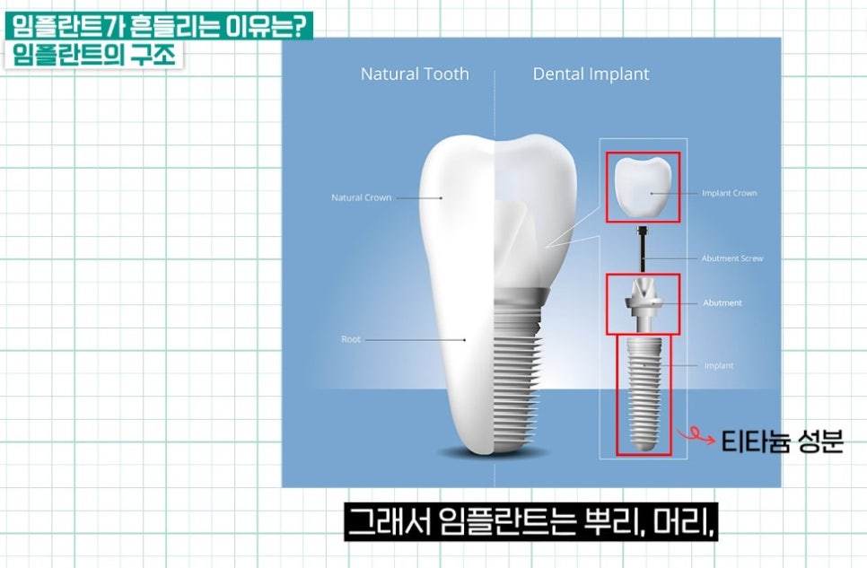 충정로치과, 임플란트가 흔들리는 이유는? 관련 이미지 2