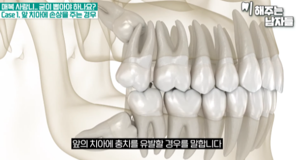 이대치과 매복사랑니, 꼭 발치해야 될까요 관련 이미지 3