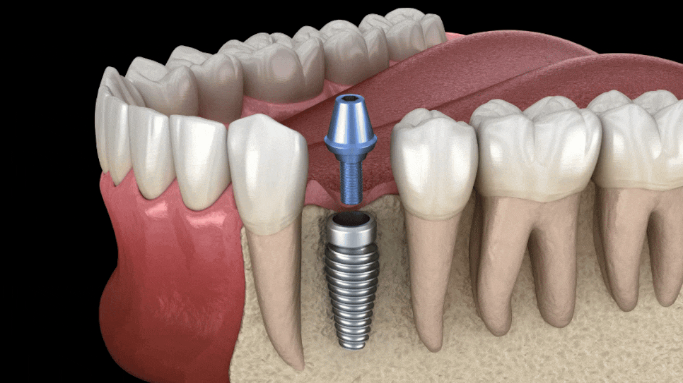 "다시 심으면 되지 않나요?" - 임플란트교체 전에 드리고 싶은 말씀 관련 이미지 2