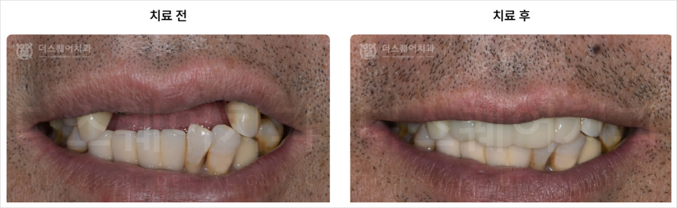 종로 임플란트 잘하는 광화문 치과 찾는 3가지 팁 공개합니다 관련 이미지 9
